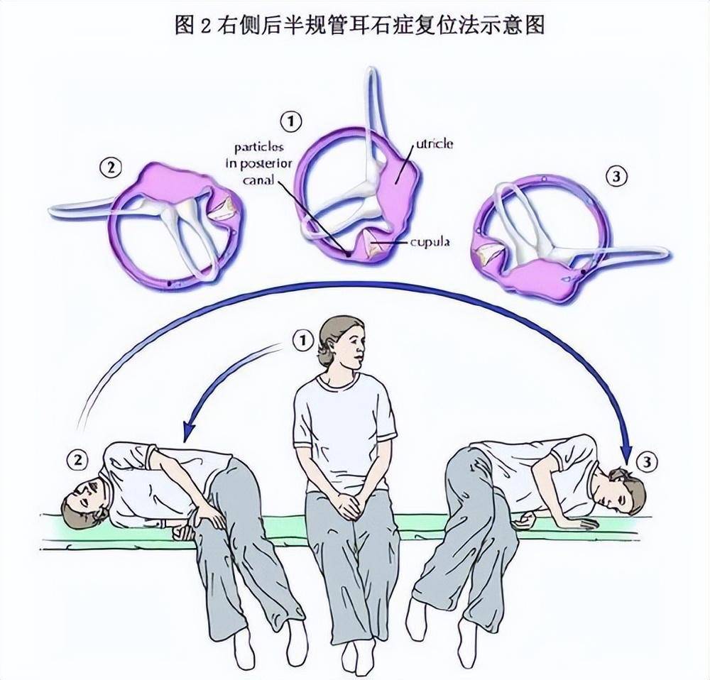 耳石復(fù)位最新技術(shù)探索，現(xiàn)代治療耳石癥的新進展